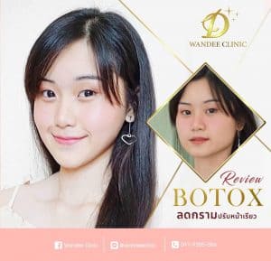 รีวิว โบท็อกซ์