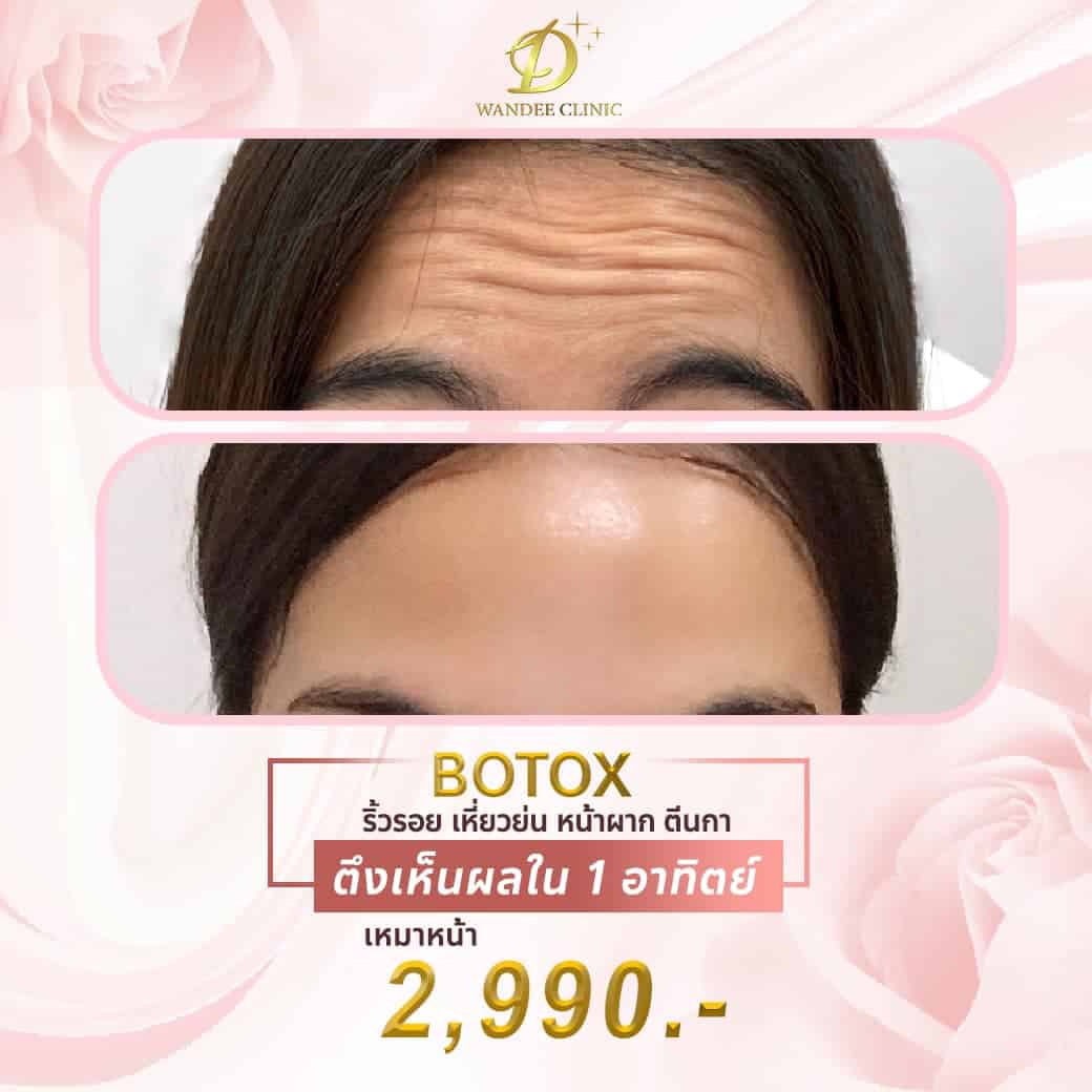 Botoxลดริ้วรอย