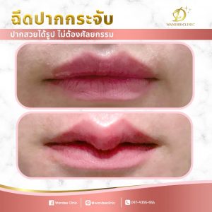 รีวิว ปากกระจับ