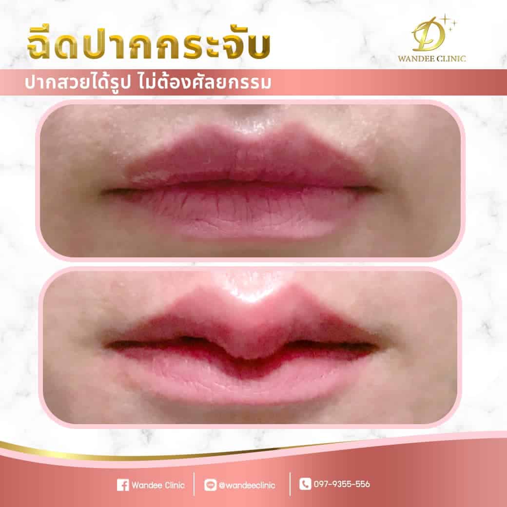 รีวิว ปากกระจับ