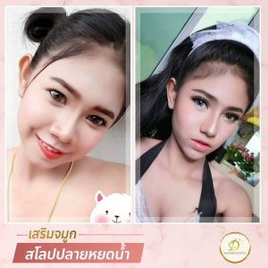 เสริมจมูก ขอนแก่น