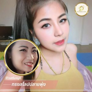 ทำจมูก ขอนแก่น