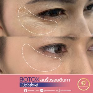 โบท็อกซ์ ลดตีนกา