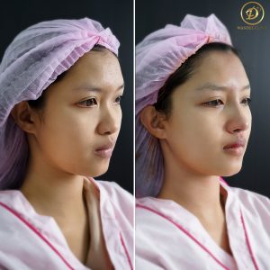 เสริมจมูกขอนแก่น