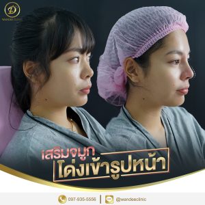 เสริมจมูกเข้ารูปหน้า