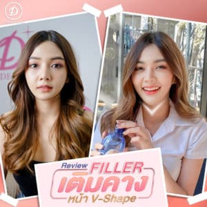 ฟิลเลอร์ขอนแก่น