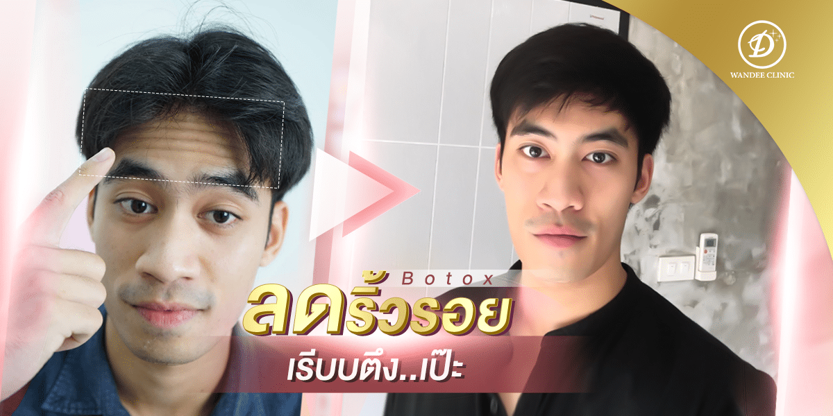 โบท็อกซ์ขอนแก่น