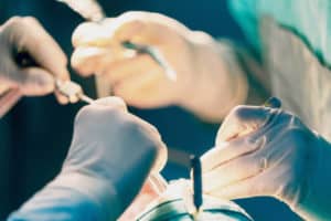 เสริมจมูกขอนแก่น2021