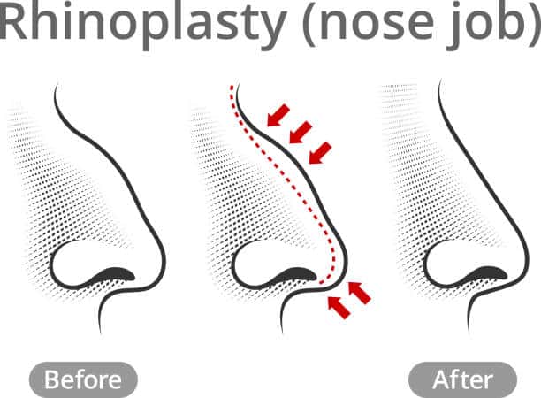 ทําจมูกขอนแก่น
