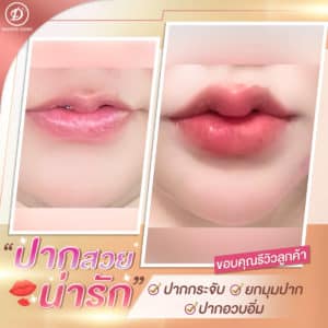 รีวิว ฟิลเลอร์ปาก