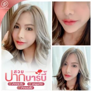 รีวิว ฟิลเลอร์ปาก