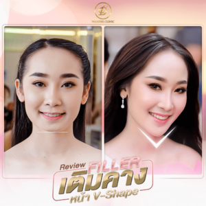 รีวิว ฟิลเลอร์ปาก