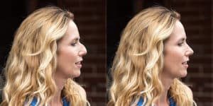 ทำจมูกซิลิโคน สายเกาหลีไม่ควรพลาด