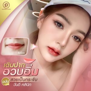 ฟิลเลอร์ปาก