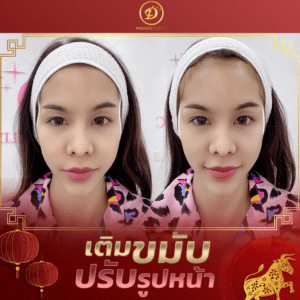 ฟิลเลอร์ขอนแก่น