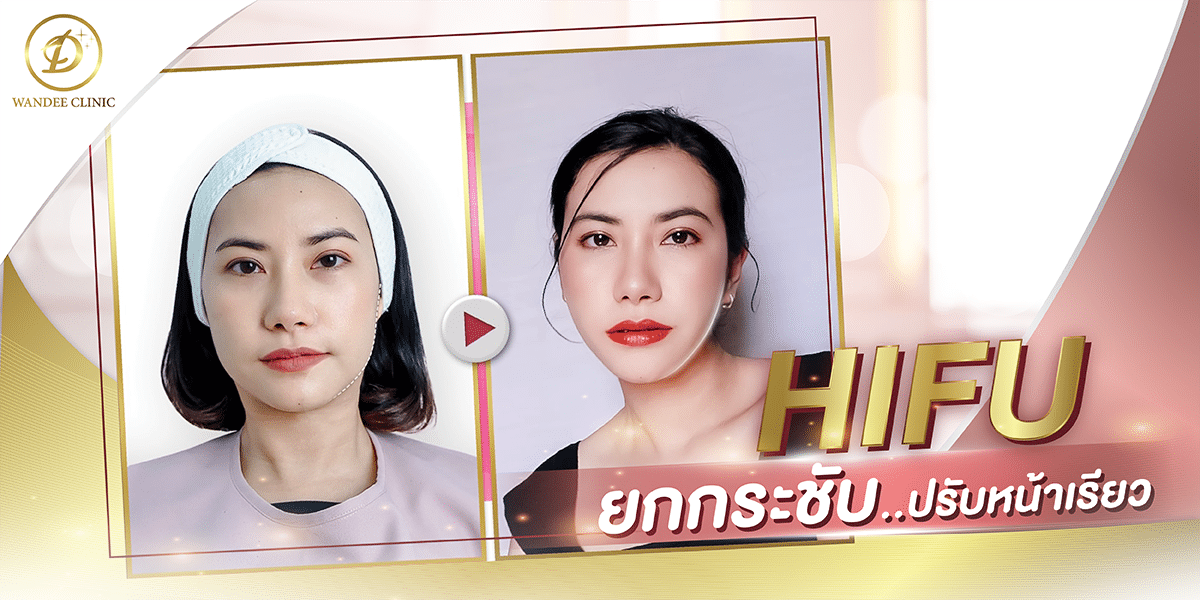 ทำHifuที่ไหนดี