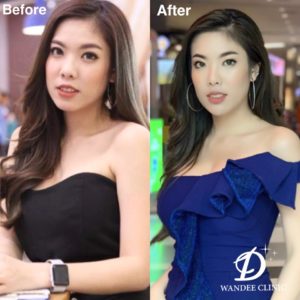 ฉีดโบท็อกซ์ที่ไหนดี