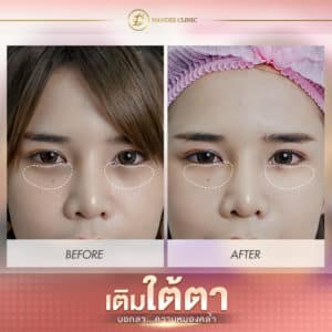 ฟิลเลอร์ขอนแก่น