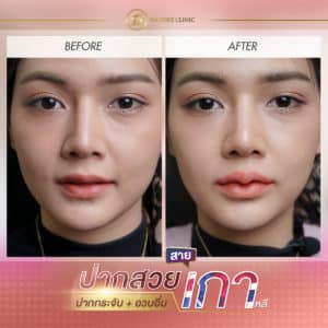 ฟิลเลอร์ขอนแก่น