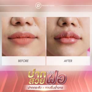 ฉีดฟิลเลอร์ที่ไหนดี