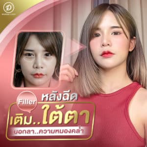 ฟิลเลอร์ขอนแก่น