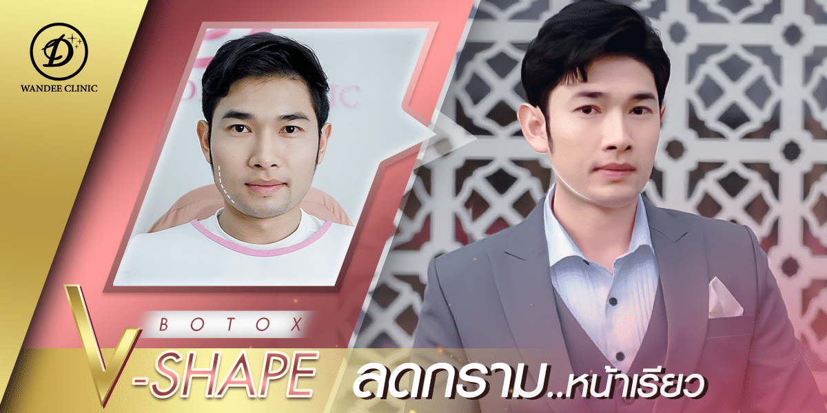 โบท็อกซ์ขอนแก่น