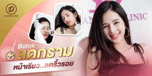 โบท็อกซ์ขอนแก่น