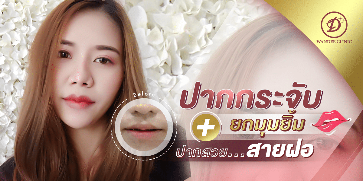 ฉีดฟิลเลอร์ที่ไหนดี