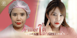 ฟิลเลอร์ขอนแก่น