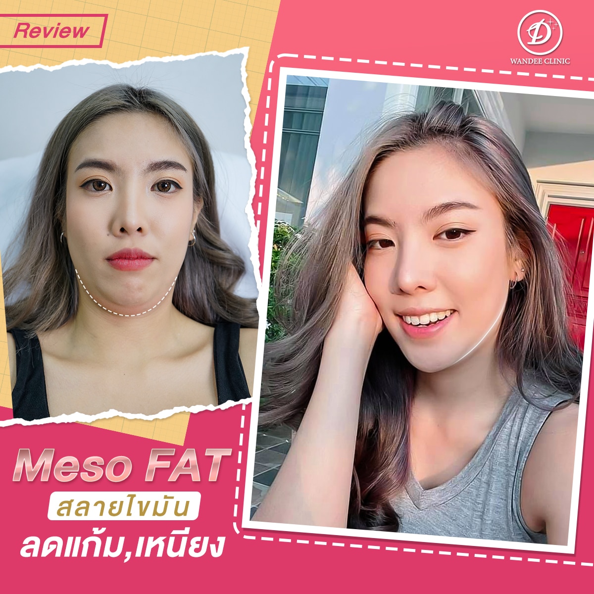 เมโสแฟต ดีจริงไหม