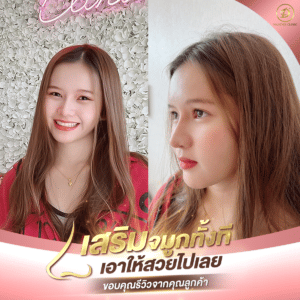 เสริมจมูก