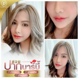 ฟิลเลอร์ปาก