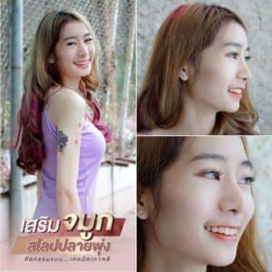 ก่อนเสริมจมูก