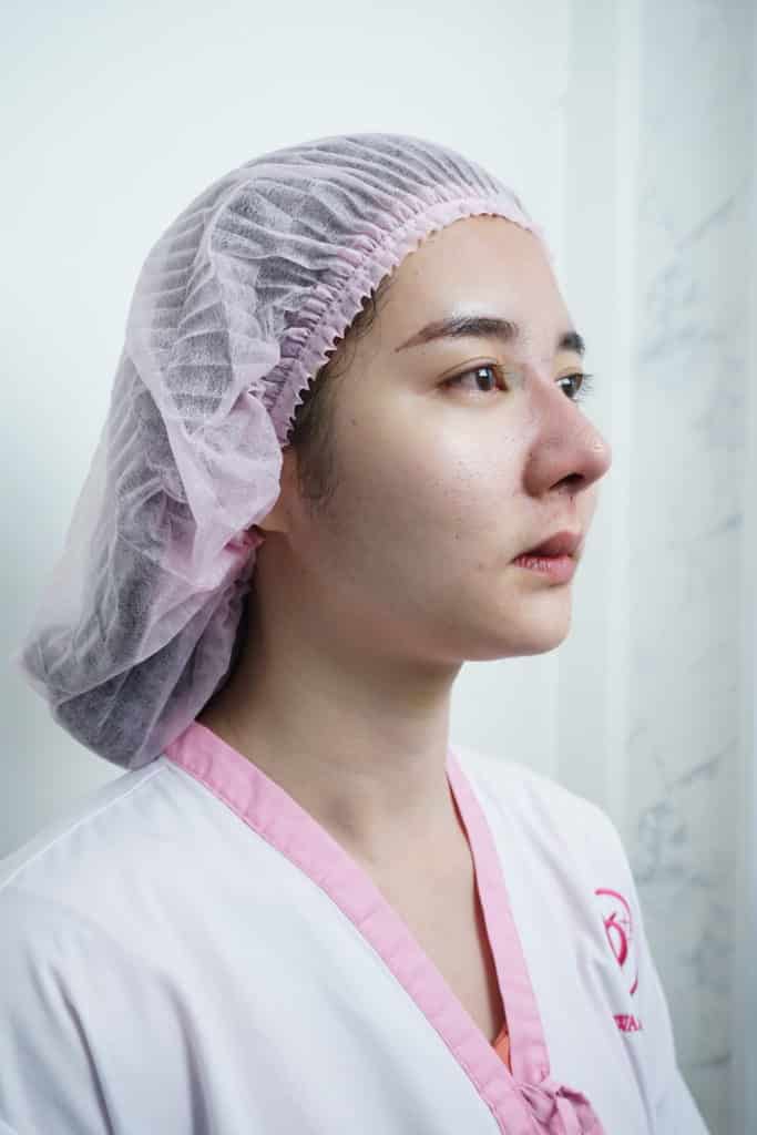 ก่อนเสริมจมูก