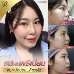 ก่อนเสริมจมูก