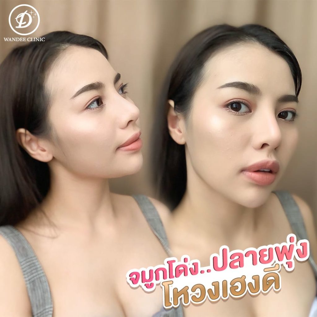 ก่อนเสริมจมูก