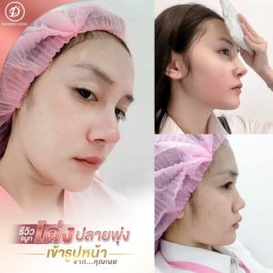 ก่อนเสริมจมูก