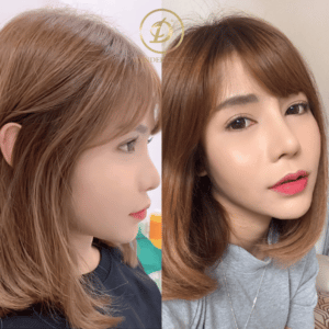 เสริมจมูก