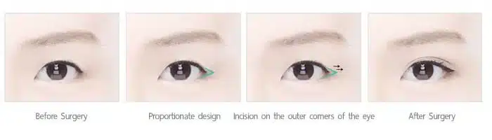 เทคนิคศัลยกรรมตาสองชั้น