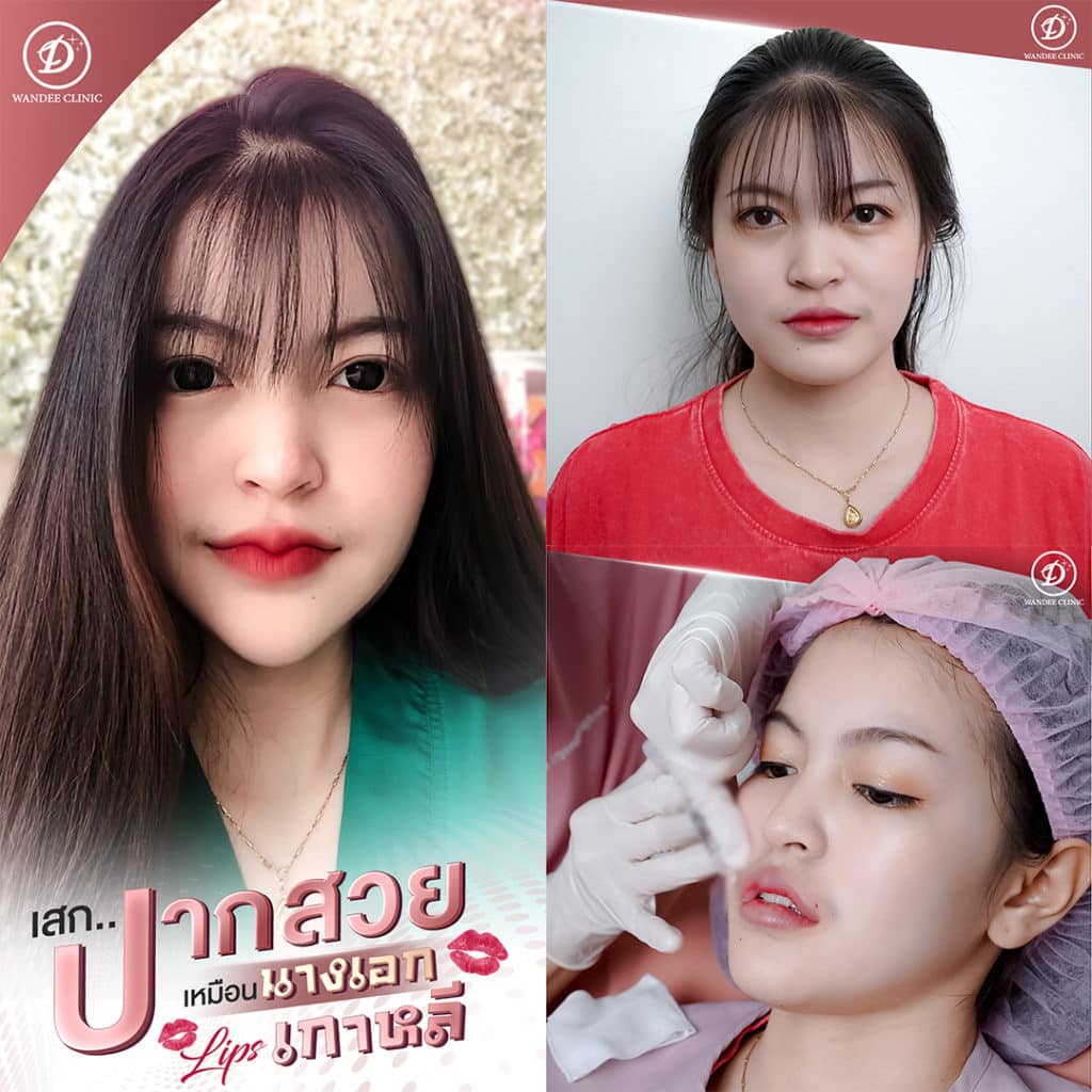 ฟิลเลอร์