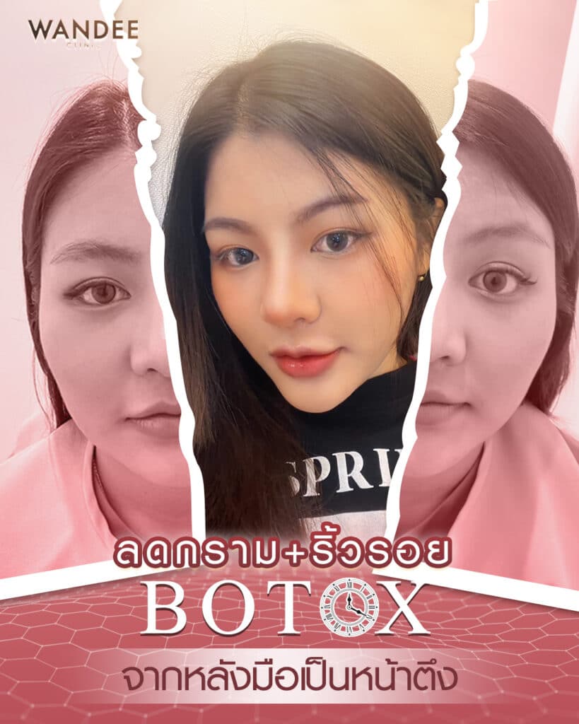 𝐁𝐨𝐭𝐨𝐱 ลดริ้วรอย+ลดกราม