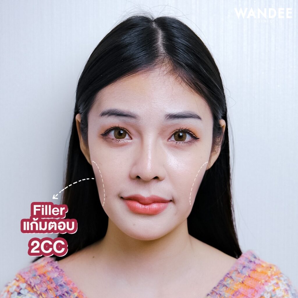 𝐍𝐞𝐮𝐫𝐚𝐦𝐢𝐬 𝐅𝐢𝐥𝐥𝐞𝐫