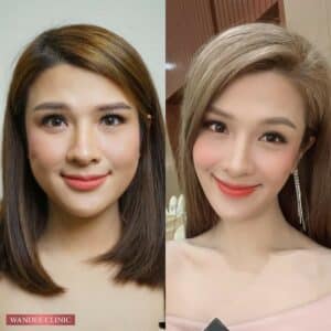 𝗕𝗼𝘁𝗼𝘅 ลดกราม