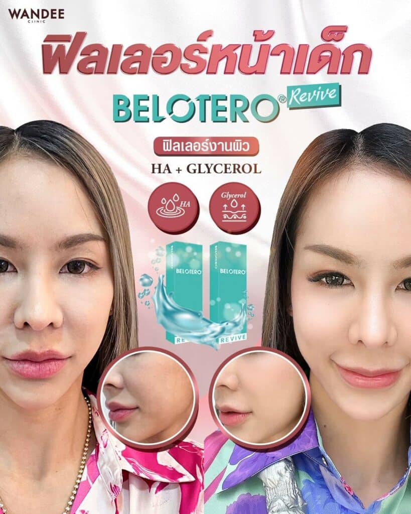 ฉีด Belotero Revive