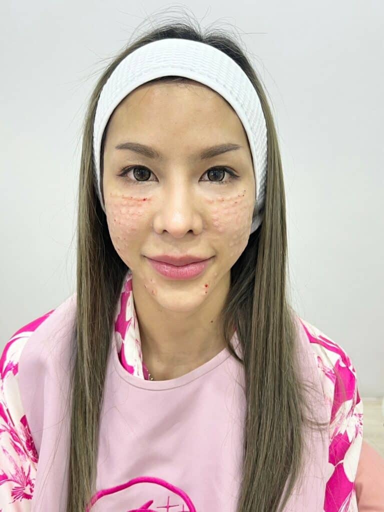 ฉีด Belotero Revive