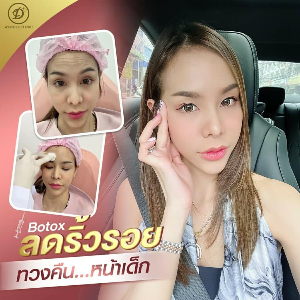 āļāļĩāļ botox āļāļĩāđāđāļŦāļāļāļĩ