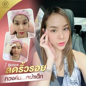 ฉีด botox ที่ไหนดี