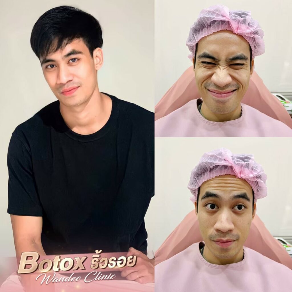 āļāļĩāļ botox āļāļĩāđāđāļŦāļāļāļĩ
