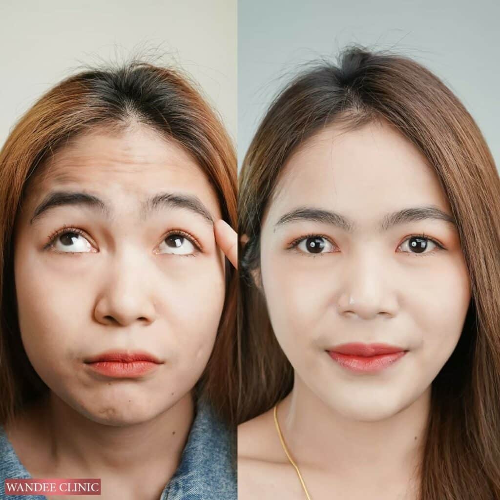 āļāļĩāļ botox āļāļĩāđāđāļŦāļāļāļĩ