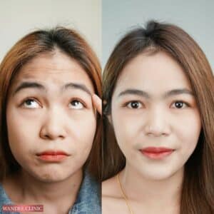 ฉีด botox ที่ไหนดี